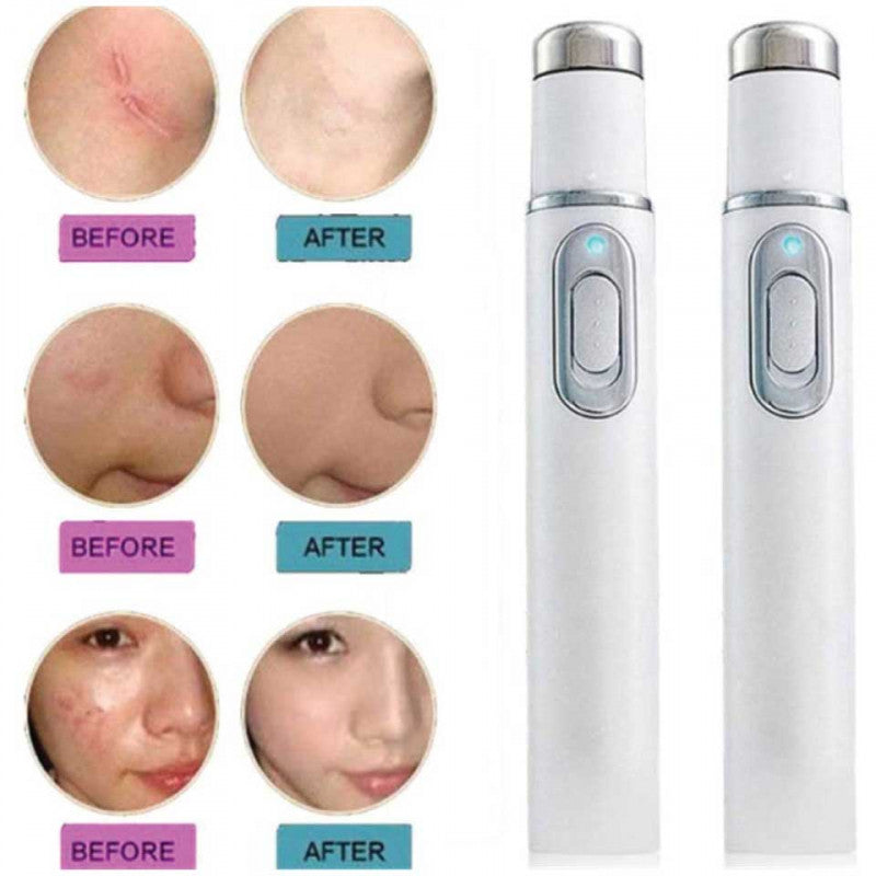 Lapiz Laser Azul Anti Hongos y Acne Import !